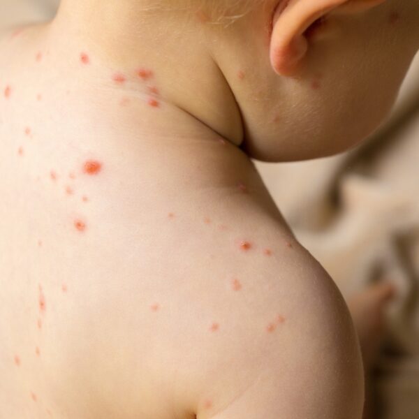 Alerta epidemiológica ante la confirmación de un caso de sarampión 