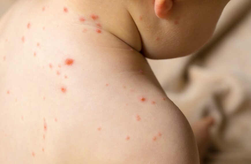 Alerta epidemiológica ante la confirmación de un caso de sarampión