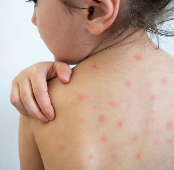 Alertan por baja vacunación y riesgo de nuevos brotes de Sarampión